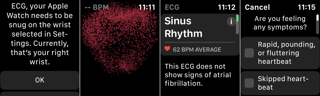 Lectura de electrocardiograma en el Apple Watch